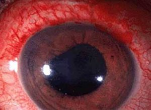 Uveitis - Gold Coast Eye & Oculoplastic Surgeons