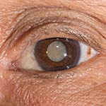 Cataract Surgery - Gold Coast Eye & Oculoplastic Surgeons