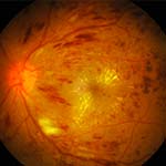 Diabetes & Macular Degeneration - Gold Coast Eye & Oculoplastic Surgeons