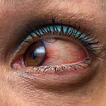 Pterygium & Uveitis - Gold Coast Eye & Oculoplastic Surgeons